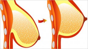 Làm cách nào nâng cấp ngực xệ thành ngực đôi mươi?