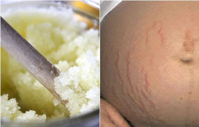2 cách trị rạn da cực nhanh và hiệu quả cho mẹ bầu