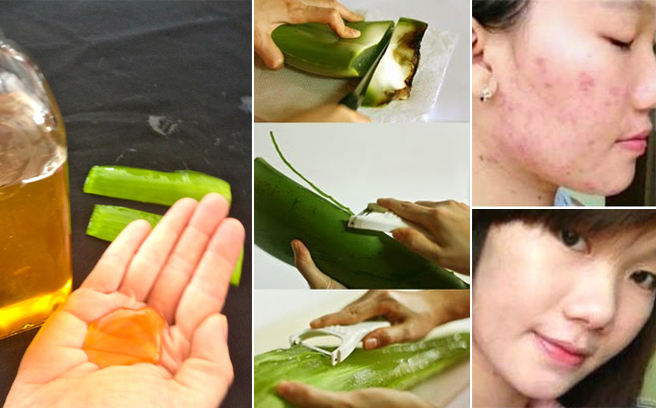 Trị sạch mụn chỉ bằng nha đam, bạn đã thử chưa?