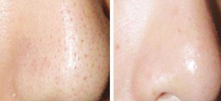 Nhật ký thu nhỏ lỗ chân lông