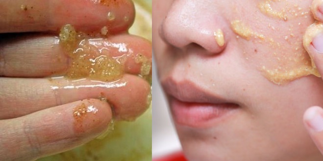 Tuyệt chiêu trắng da cho làn da nhờn mụn chỉ bằng bột quế + sữa tươi