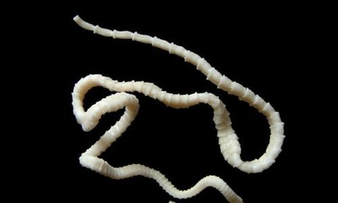 Con sán dài 8 cm trong não người phụ nữ thích uống nước lã