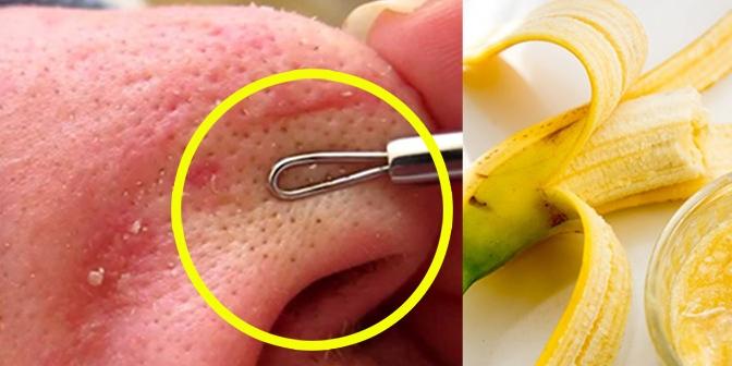 Độc chiêu khiến mụn cám tự chui ra không cần phải nặn