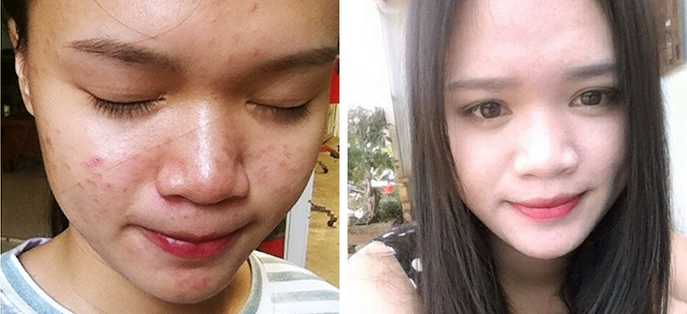 Cô gái trị sạch mụn trong 2 tháng bằng bột đậu xanh