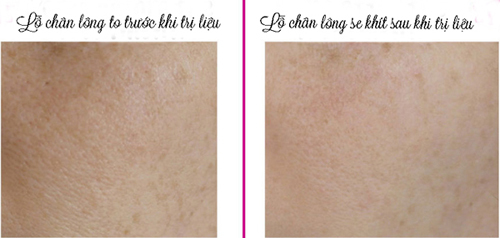 Nhật ký thu nhỏ lỗ chân lông to vĩnh viễn trong vòng 17 ngày