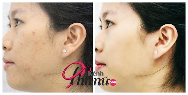 Tôi đã trị mụn, xóa vết thâm thành công!