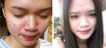 Cô gái trị sạch mụn trong 2 tháng bằng bột đậu xanh
