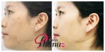 Tôi đã trị mụn, xóa vết thâm thành công!