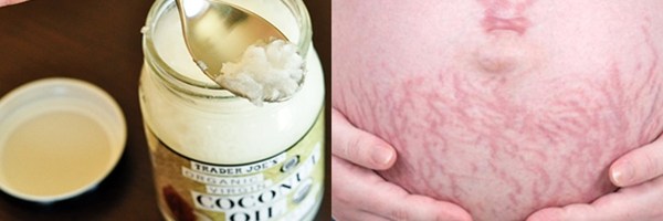 6 cách chữa rạn da lý tưởng cho mẹ bầu