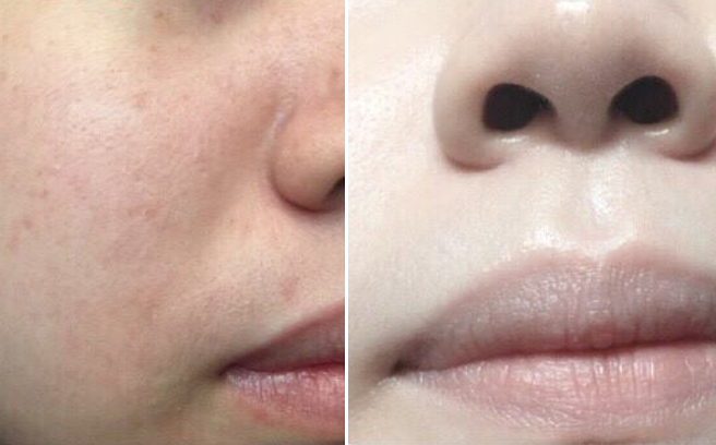 Tuyệt chiêu siêu dễ giúp đánh bay 100‰ mụn ẩn dưới da