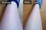Trị khỏi viêm nang lông với nguyên liệu rẻ tiền mà hiệu quả