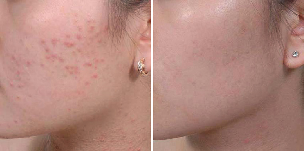Tuyệt chiêu siêu dễ giúp đánh bay 100&permil; mụn chìm, mụn ẩn li ti dưới da
