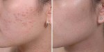 Tuyệt chiêu siêu dễ giúp đánh bay 100% mụn chìm, mụn ẩn li ti dưới da
