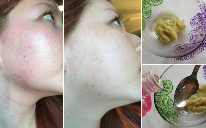Trị mụn siêu tốc với mặt nạ gừng tại nhà