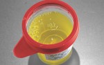 Màu sắc nước tiểu tiết lộ vấn đề sức khỏe