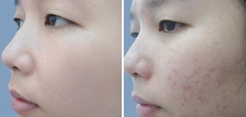Hỗn hợp siêu rẻ, cực an toàn giúp đánh bay vết thâm chỉ sau 2 tuần