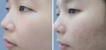 Hỗn hợp siêu rẻ, cực an toàn giúp đánh bay vết thâm chỉ sau 2 tuần