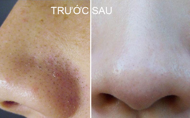 Bí quyết cực hay thổi bay mụn đầu đen cho da sáng mịn đón Tết
