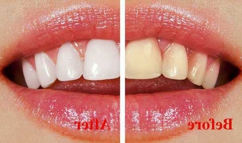 Hỗn hợp đặc biệt giúp răng ố vàng đến đâu cũng trở nên sáng bóng