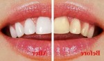 Hỗn hợp đặc biệt giúp răng ố vàng đến đâu cũng trở nên sáng bóng