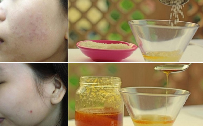 Bỏ túi mẹo trị mụn cấp tốc tại nhà bằng dấm táo