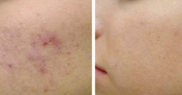 Da em đã trắng mịn, mụn giảm 80&permil; chỉ sau 3 ngày