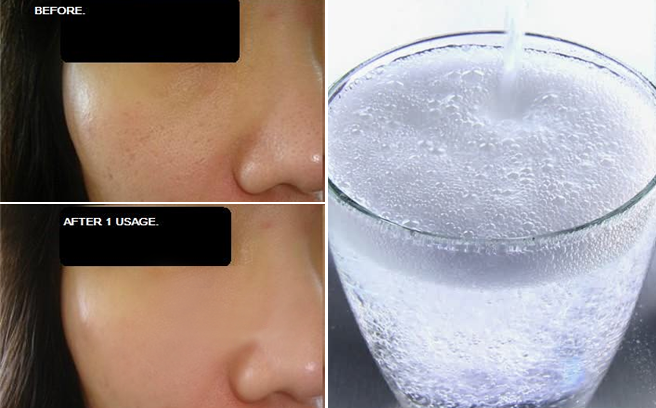 Mẹo se lỗ chân lông độc đáo từ nước có gas. Không thử đừng tiếc!