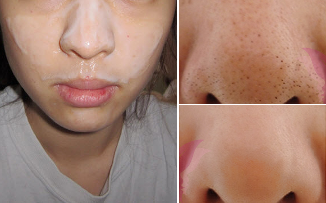 4 mẹo giúp loại bỏ trong nháy mắt mụn đầu đen trên da