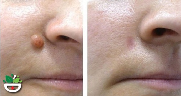 Cách trị mụn cóc, mụn cơm với giấm táo không để lại sẹo