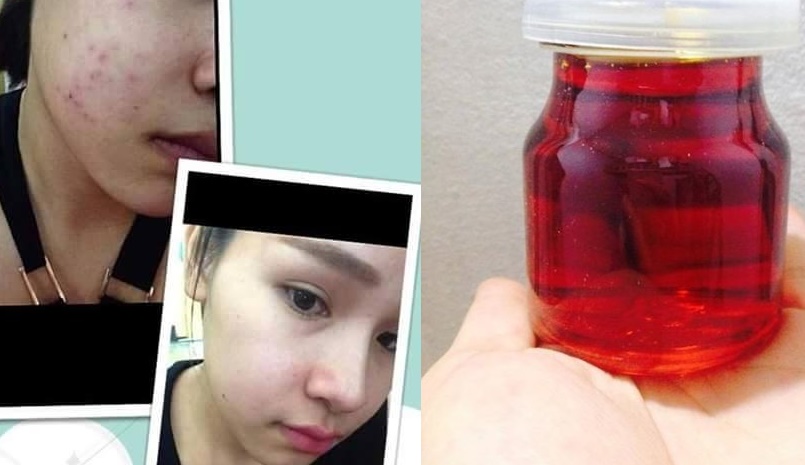 Da sạch mụn, trắng mịn màng nhờ loại quả ai cũng thích ăn