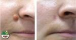 Cách trị mụn cóc, mụn cơm với giấm táo không để lại sẹo