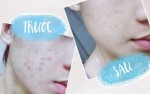 Tôi đã xử lý thâm mụn thành công trong 1 tháng bằng lô hội