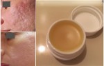 Công thức kem dưỡng trị sẹo vĩnh viễn trong vòng 2 tuần