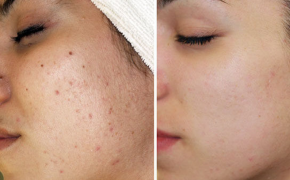 Xóa sổ mụn ẩn - tưởng khó hóa dễ như chơi