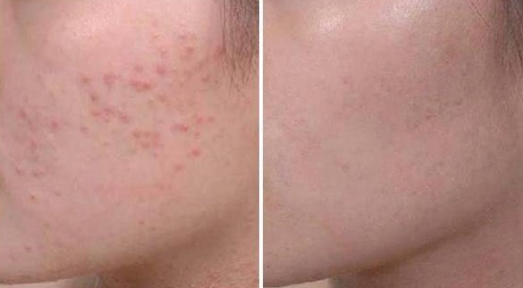 Đắp công thức này, tất cả các loại mụn tự chui ra mà không cần nặn