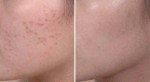Đắp công thức này, tất cả các loại mụn tự chui ra mà không cần nặn