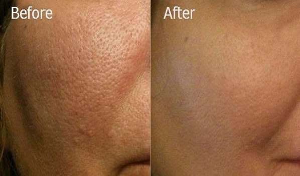 Cách se nhỏ lỗ chân lông hiệu quả hơn các loại kem đắt tiền