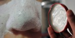 Diệt triệt mụn đầu đen "lì lợm" bằng cách đơn giản không ngờ