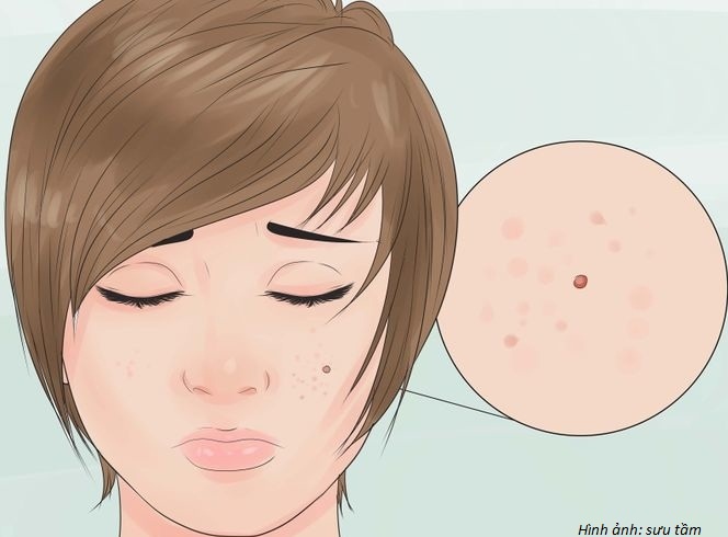 Mụn nhiều tới đâu cũng khỏi chỉ bằng 1 cách duy nhất