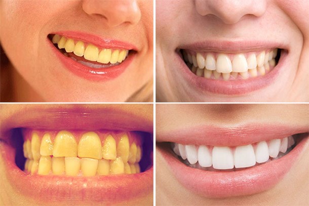 6 Tuyệt Chiêu Tẩy Sạch Cao Răng Mãi Mãi