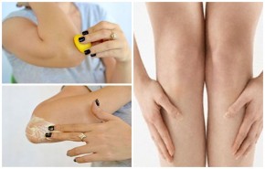 Xóa Vĩnh Viễn Vết Thâm Ở Đầu Gối , Khuỷu Tay Và Nách Ngay Tại Nhà