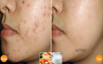 Mụn mãi không hết, áp dụng cách này sẽ thấy điều kì diệu