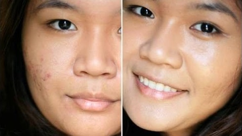 Hỗn hợp rẻ tiền giúp đánh bay vết thâm mụn chỉ sau 14 ngày