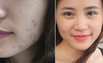 Đắp mặt nạ thần thánh này không cần nặn mụn cũng tự ra!