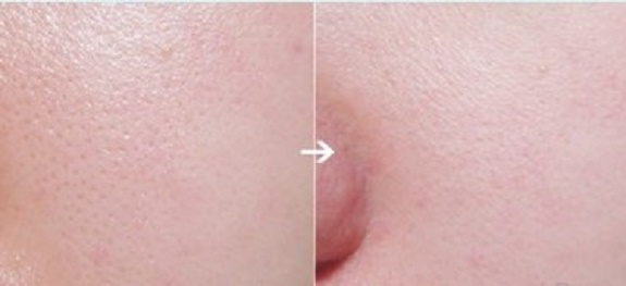 8 Cách tự nhiên xóa sạch lỗ chân lông to trên da vĩnh viễn