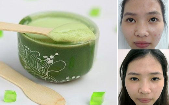 Mẹo trị mụn trứng cá cấp tốc sau Tết, 1 ngày lặn ngay!