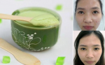 Mẹo trị mụn trứng cá cấp tốc sau Tết, 1 ngày lặn ngay!