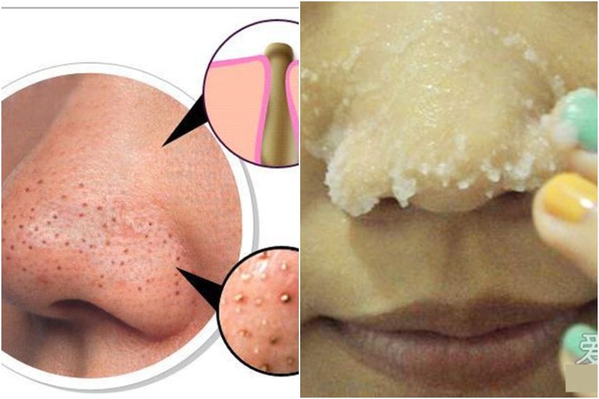 Loại bỏ mụn đầu đen trên mũi và má chỉ với 2000 đồng nguyên liệu