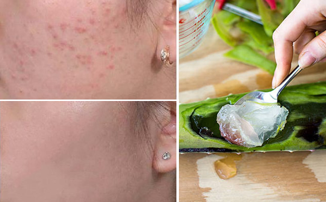 Mẹo hay trị thâm mụn da sáng lung linh cho nàng sau Tết