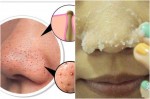 Loại bỏ mụn đầu đen trên mũi và má chỉ với 2000 đồng nguyên liệu